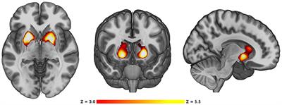 Larger Gray Matter Volume in the Basal Ganglia of Heavy Cannabis Users Detected by Voxel-Based Morphometry and Subcortical Volumetric Analysis